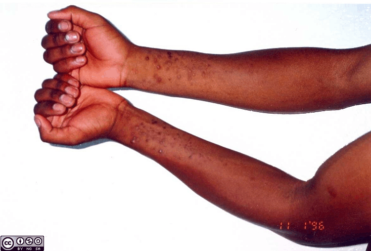 Management of An Occupational Diseases Page 1 of 1